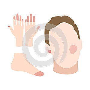 Face, hand and foot with frostbite symptoms, allergy or skin burn. Skin redness, erythema, hypothermia. Flat vector illustration photo