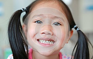 Face of little Asian child girl with a teeth broken and rotten