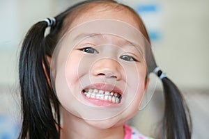 Face of little Asian child girl with a teeth broken and rotten