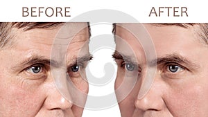 Face of a mature man before and after cosmetic rejuvenating procedures