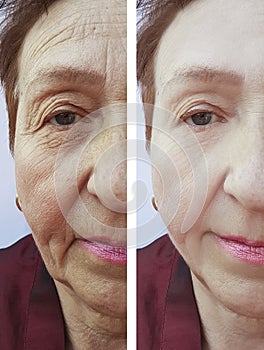 Face of an old woman removal wrinkles filler regeneration treatmentbefore and after procedures