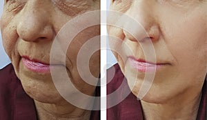 Face of an old woman removal wrinkles liftingfiller regeneration treatmentbefore and after procedures