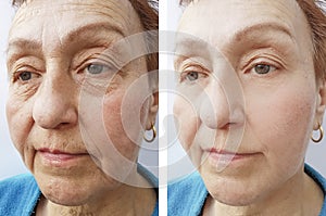 Face of an old woman removal wrinkles regeneration treatmentbefore and after procedures