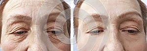 Face of an old woman treatment lifting wrinkles correction before and after procedures