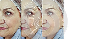 Face old woman wrinkles before  after cosmetology  arrow plastic correction mature tension rejuvenation treatment photo