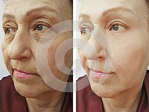Face of an old woman wrinkles lifting filler regeneration treatmentbefore and after procedures