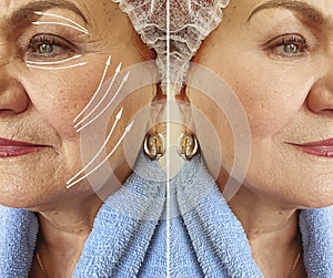 Face old woman wrinkles problem before and after treatment, arrow, thread lifting