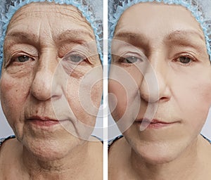 Face of an old woman wrinkles results treatment medicine before and after procedures