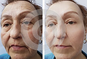 Face of an old woman wrinkles treatmentbefore and after procedures