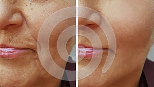 Face of an old wrinkle woman before and after photo