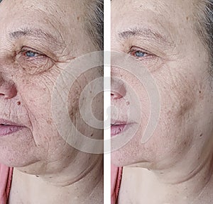 Face an older woman before and after difference treatments