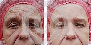 Face of an older woman lifting retouch therapy regeneration before and after treatments