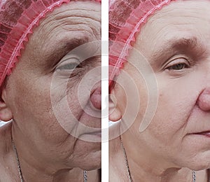 Face of an older woman before and after treatments