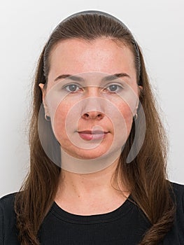 Face of patient with papulopustular rosacea in remission