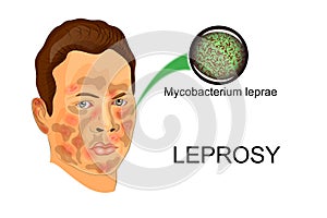 The face of the patient suffering from leprosy photo