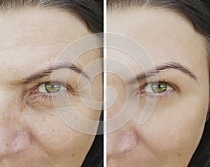 Face patient wrinkles before and after antiaging collagen eye procedure filler antiaging removal