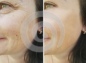 Face patient wrinkles before and after filler antiaging removal