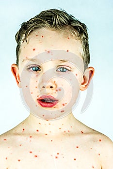 Face portrait of sick boy with chickenpox infection, rash and blisters. photo