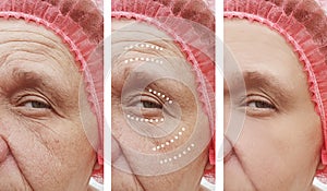 Face senior of older woman injection difference removal therapy rejuvenation before and after treatments