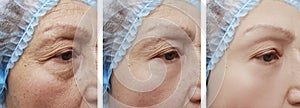 Face senior of older woman old, senior collagen rejuvenation before and after treatments