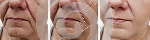 Face senior of an older woman rejuvenation before and after treatments