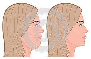 Face side view_Double chin removal