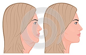 Face side view facelift before and after