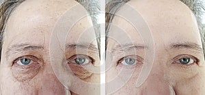 Face skin an older woman before and after difference treatments