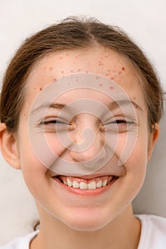 Face of a teenage girl with pimples, acne on the skin, portrait of a cool happy teen girl