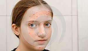 Face of a teenage girl with pimples, acne on the skin, portrait of puberty girl