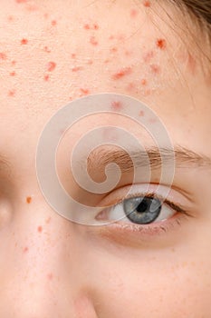 Face of a teenage girl with pimples, acne on the skin, portrait of puberty girl