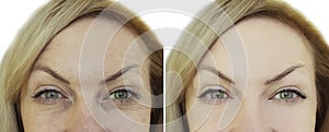 Face of woman`s wrinkle before and after e yes