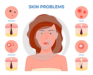 Face of a woman with skin problems. Pimples. Dirty unkempt skin. Vector illustration