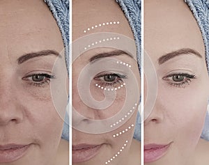 Face woman skin wrinkles removal dermatology before and after aging cosmetology procedures