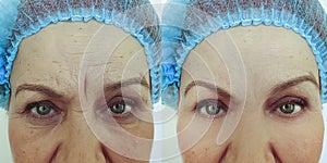 Face  woman wrinkles before and after difference  effect   tension therapy cosmetology lifting result difference treatment