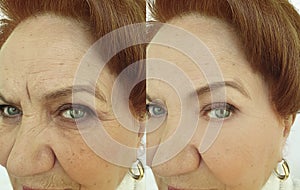 Face woman wrinkles before and after  hydrating  sagging tension treatment