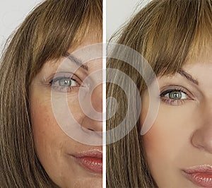 Face woman wrinkles before and after lifting results cosmetology therapy