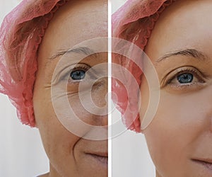 Face woman wrinkles patient dermatology before and after cosmetic anti-aging procedures