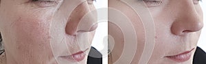 Face woman wrinkles before and after procedures