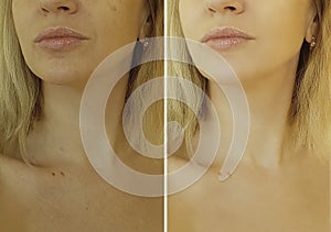 Face woman wrinkles before and after