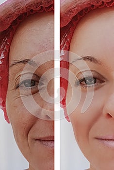Face woman wrinkles before and after removal cosmetic procedures