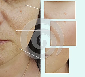 Face woman wrinkles therapy correction concept treatment before and after procedures, pigmentation