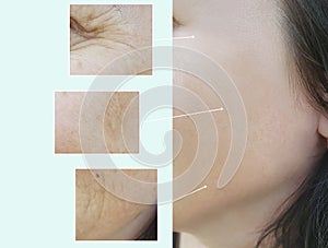 Face woman wrinkles therapy correction lift concept treatment before and after procedures, pigmentation