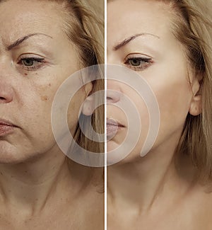 Face woman wrinkles before and after procedure revitalization photo