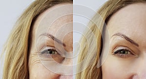 Face wrinkle woman before and after