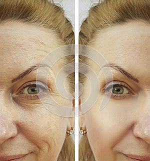 Face wrinkle woman before and after correction