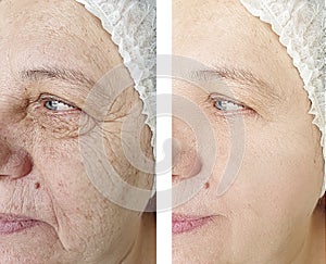 Face wrinkles elderly woman  difference before and after rejuvenation treatment