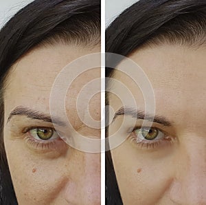 Face wrinkles before and after filler antiaging removal