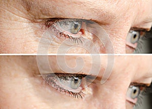 Face wrinkles removal photo