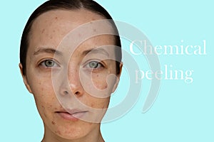 Face of a young girl after a cosmetic procedure of chemical peeling
